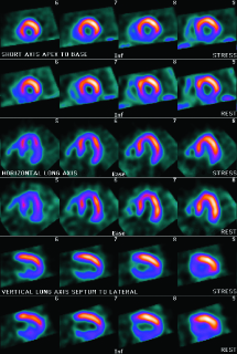 myocardial perfusion scan